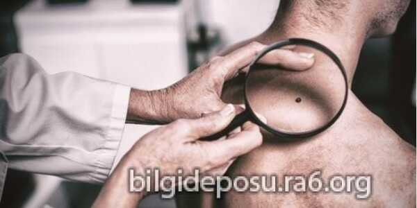 Cilt kanserinde doğru teşhis hayat kurtarır