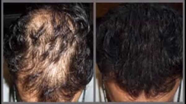 elma sirkesinin sac cikarmasi scaled - Bilgideposu