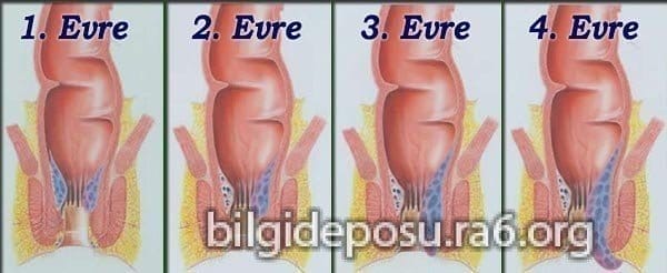 Hemoroid(Basur) Evreleri