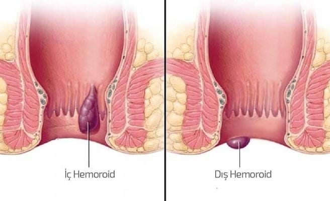 Basur nedir? Basur Tedavisi ve Belirtileri - Bilgideposu İç basur ve dış basur- Basur nedir?