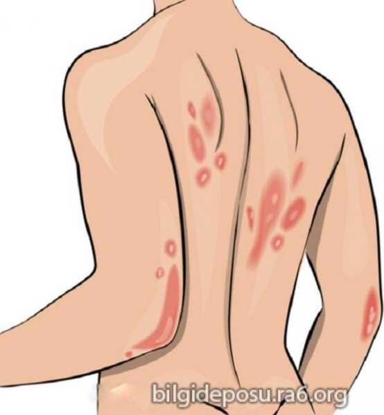 Kan şekeri yüksekliği sırttaki yaralar ve sivilceler