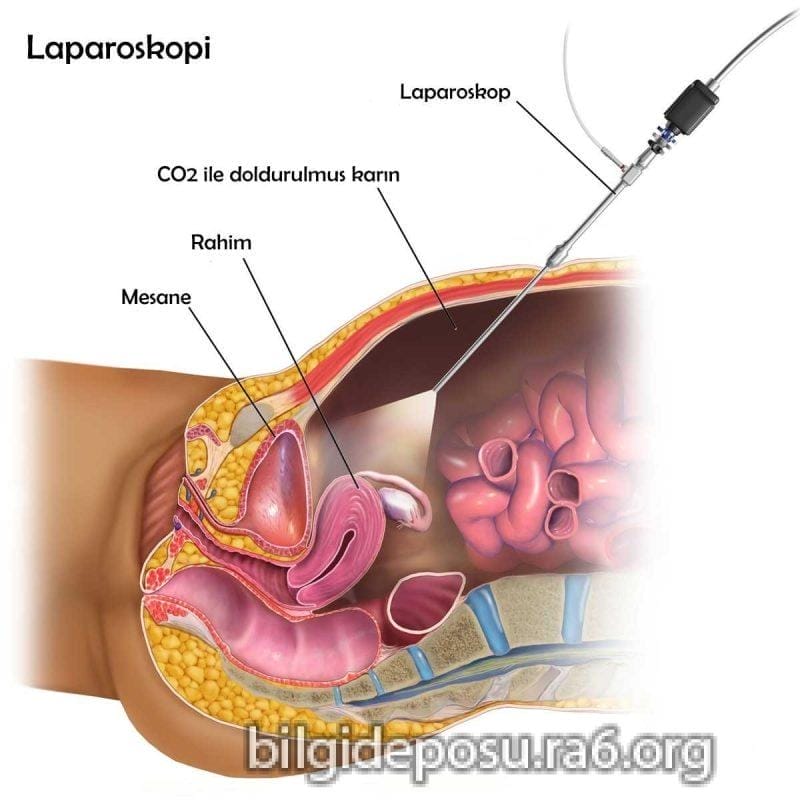 laparoskopp - Bilgideposu