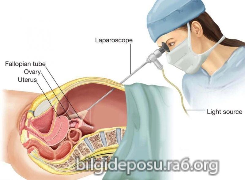 laporoskopi - Bilgideposu