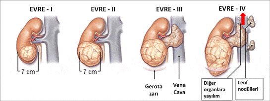 prostat kanseri evreleri bilgideposu - Bilgideposu
