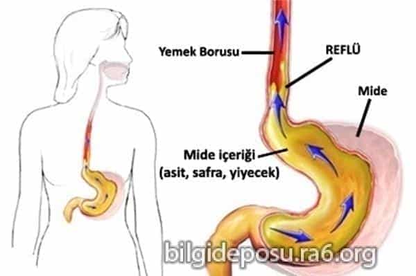 Reflü nasıl geçer? Reflü nasıl iyileşir?